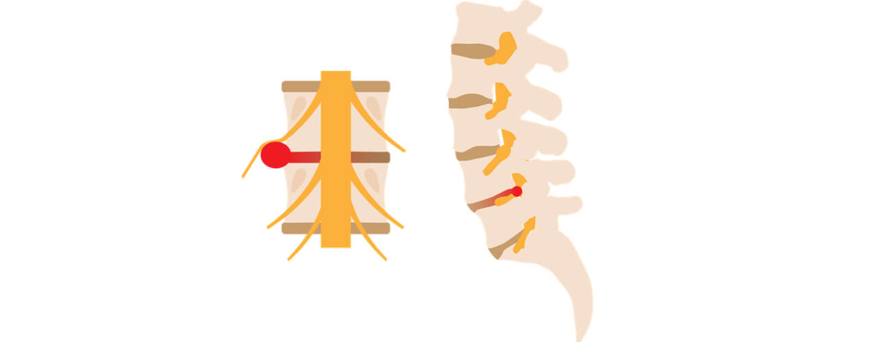 Physiotherapy for Herniated Disc Treatment: What You Need to Know