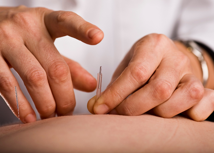acupuncture-regent-health-centre-hamilton-on